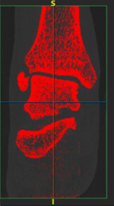 Bone regions highlighted in red in a CT scan illustrating the segmentation process